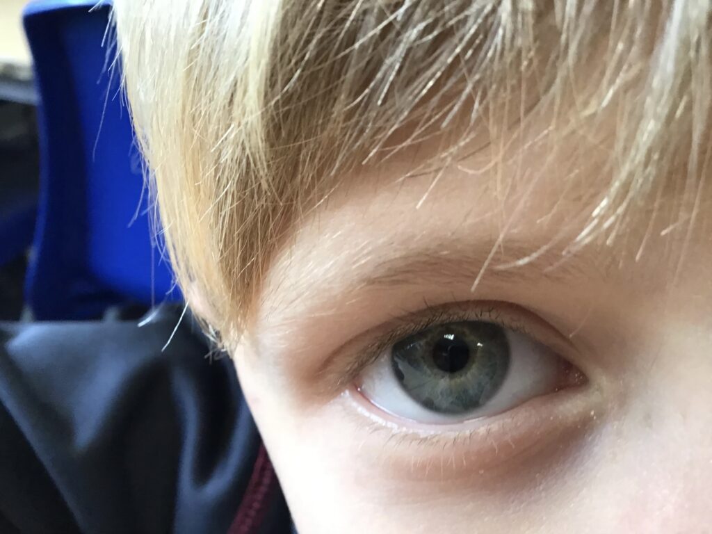 Eye 1